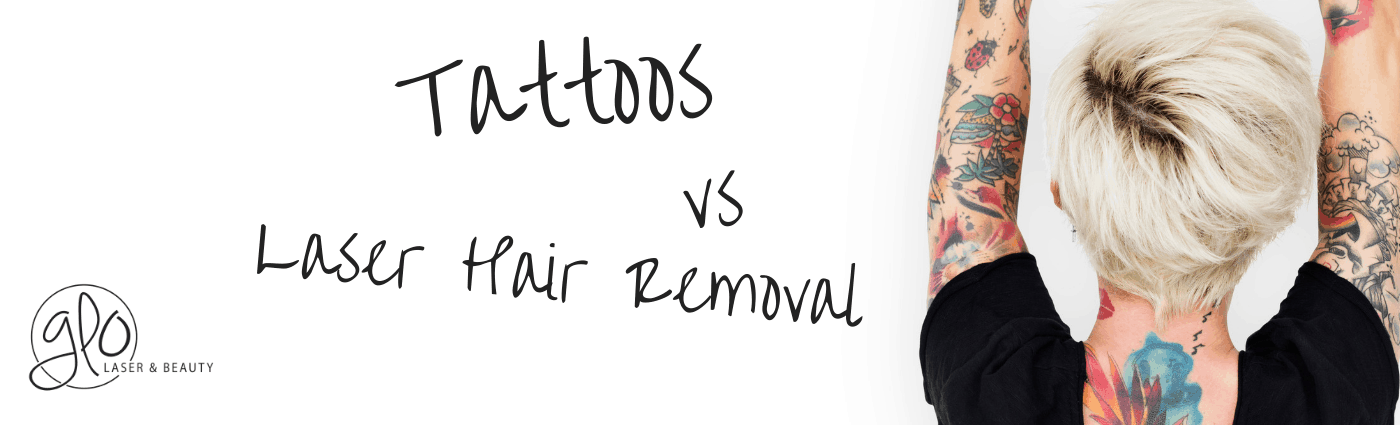 Tattoos vs Laser Hair Removal