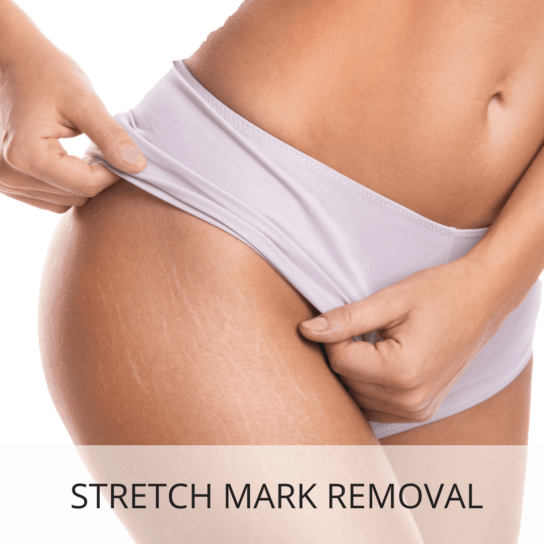 4 Easy Ways to Get Rid of Stretch Marks